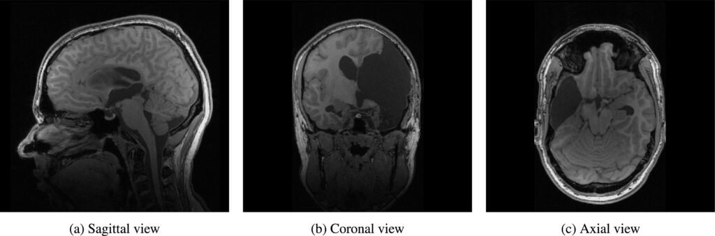 The image displays three MRI brain scans from different anatomical perspectives: (a) sagittal, (b) coronal, and (c) axial views. The sagittal view (left) shows a side profile of the brain, including the cerebral cortex and cerebellum. The coronal view (middle) presents a front-facing cross-section, revealing the brain's internal structures. The axial view (right) provides a horizontal cross-section, illustrating the top-down perspective. The coronal and axial scans show significant structural abnormalities, including a large region of missing brain tissue, suggesting a post-surgical or pathological condition, such as a hemispherotomy or severe brain atrophy.