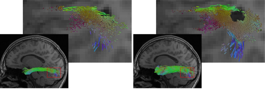 The image shows fiber tract reconstructions of the inferior longitudinal fasciculus (ILF) in the intact hemisphere of a hemispherotomy patient. The bottom row displays sagittal MRI brain scans with tractography overlays, where the ILF is highlighted in green, blue, and other colors. A red rectangle marks a region of interest. The top row presents zoomed-in views of this region, focusing on the differences between two reconstruction methods. On the left, TractSeg includes streamlines within a lesion, while on the right, the proposed regularized low-rank reconstruction excludes the lesion more accurately. The visualization highlights the tractography differences, with the right-side method maintaining a more precise exclusion of the lesion despite segmenting a larger overall tract volume.