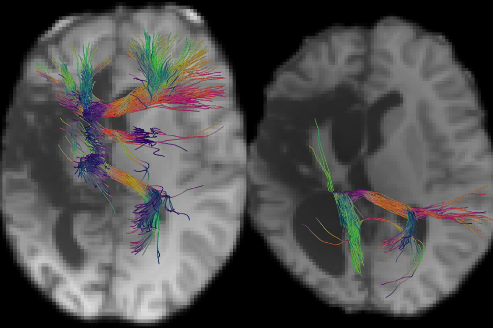 The image shows two axial MRI brain scans overlaid with tractography visualizations of white matter fiber tracts. The left scan displays a more intact brain with extensive fiber tracts extending in multiple directions, visualized in different colors indicating fiber orientation. The right scan, however, exhibits a large region of missing brain tissue, likely due to a surgical intervention such as a hemispherotomy. The fiber tracts in this hemisphere are significantly reduced, with disrupted connections and fewer streamlines, reflecting the structural changes caused by the procedure. The image highlights differences in white matter organization between an intact and a surgically altered brain.